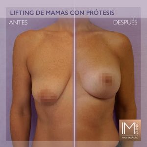 lifting-mamas-protesis-im-clinic