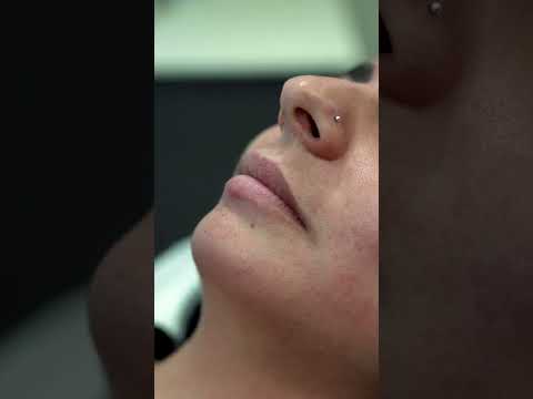 Aumento de Labios. Medicina Estética IM CLINIC #shorts