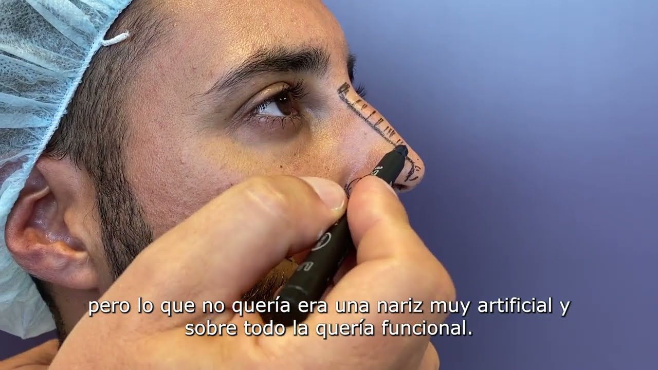 Cómo solucionar problemas de respiración gracias a la Rinoplastia