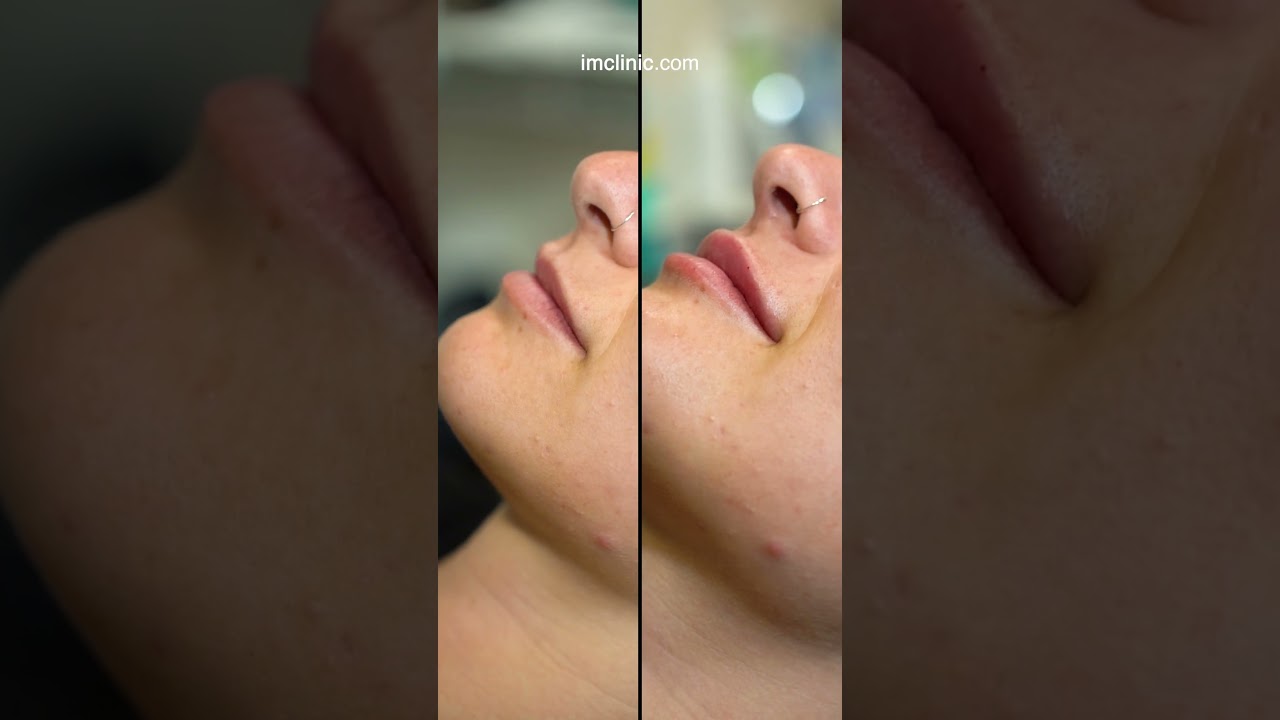 Nuevo caso de hidratación de labios #shorts