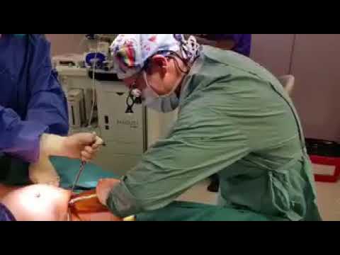 Colocar una prótesis grande vía axilar en un aumento de mamas