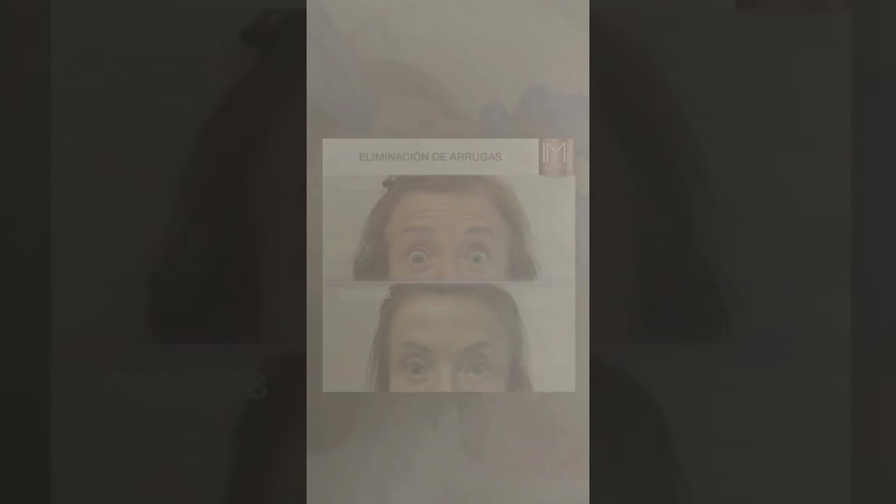 Tratamiento para difuminar arrugas del contorno de ojos y frente