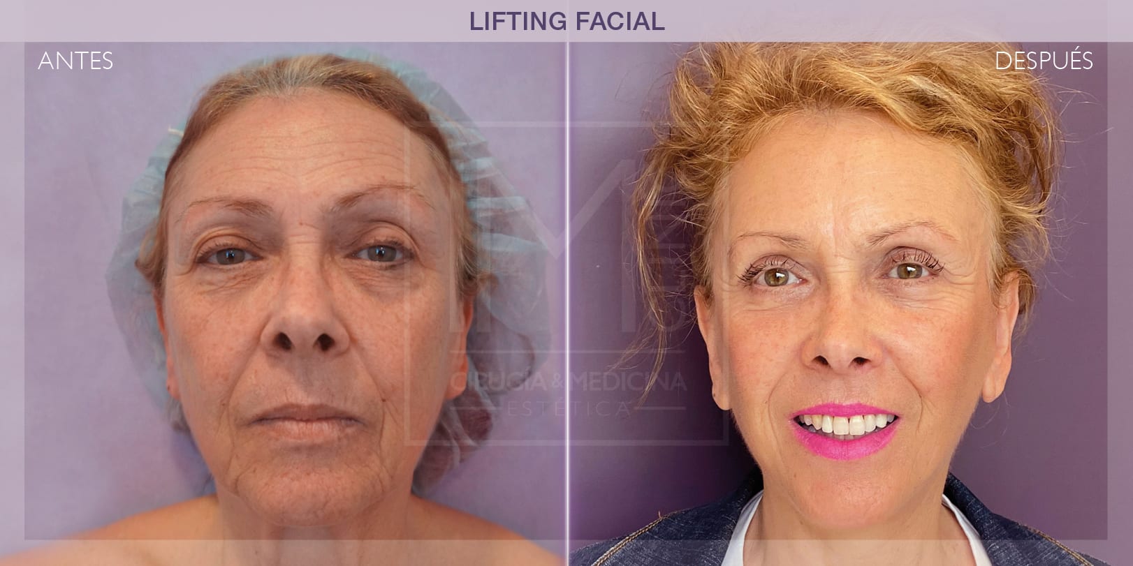 Rejuvenecimiento facial mediante lifting: antes y después