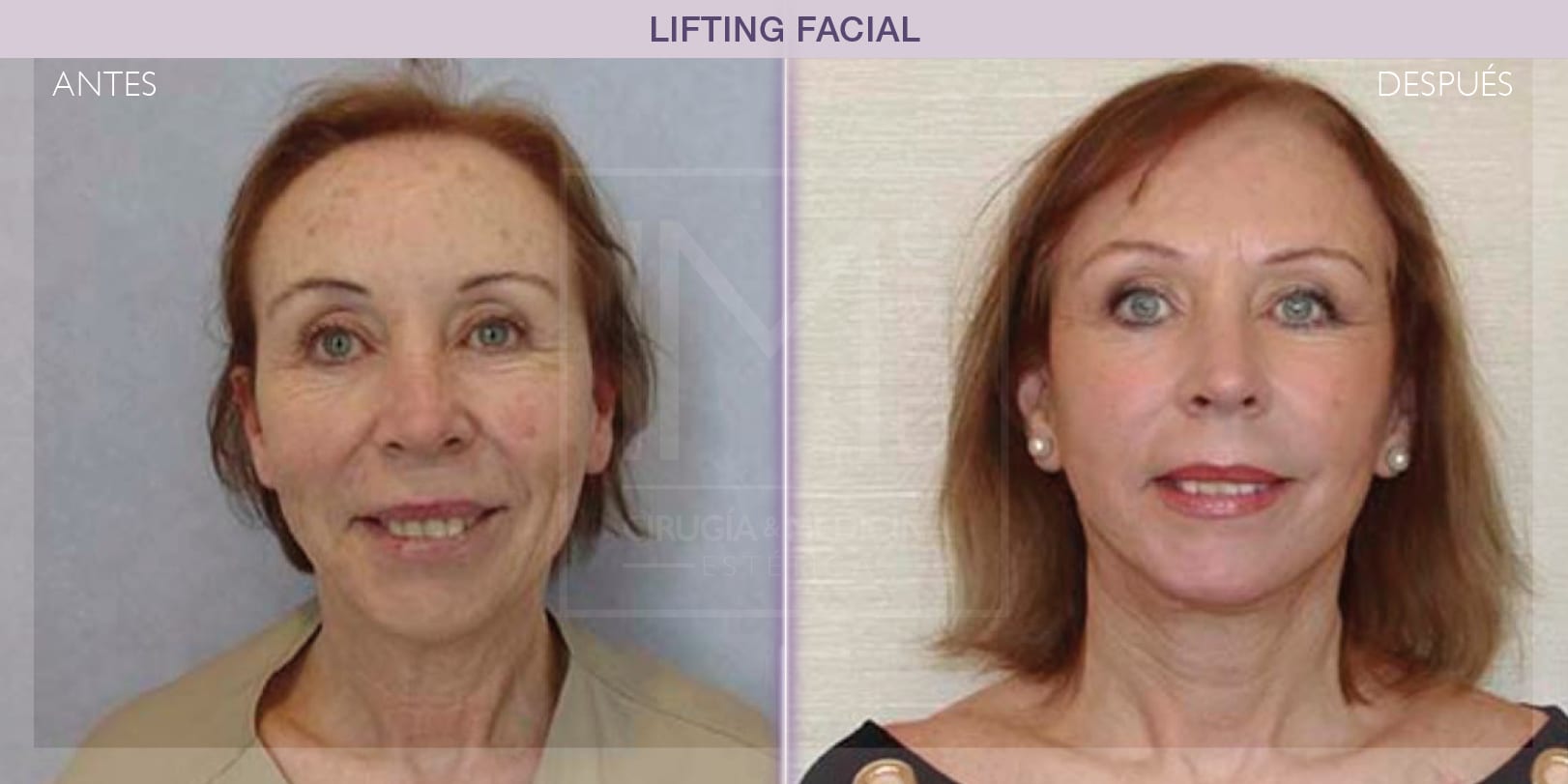 Lifting facial: rejuvenecimiento y mejora de contornos antes y después