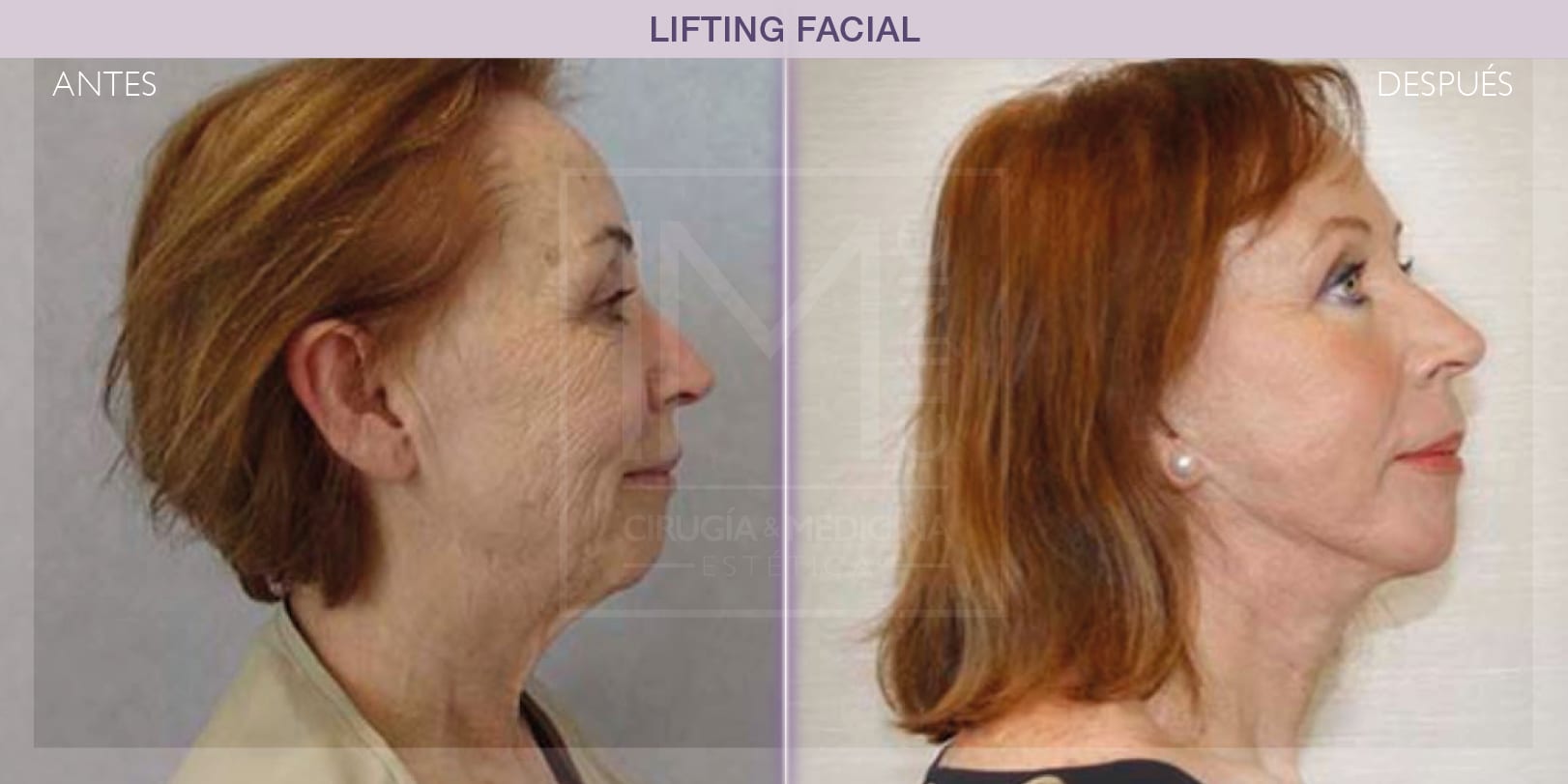 Rejuvenecimiento facial: comparativa antes y después del lifting
