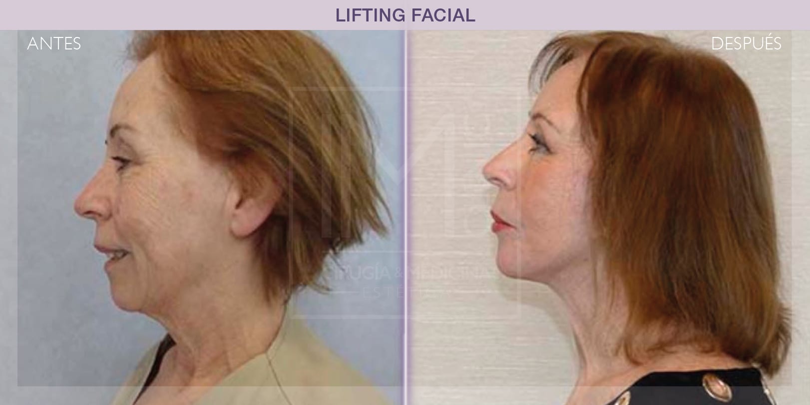 Transformación facial tras lifting
