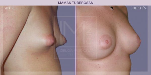 antes y después de la operación de mamas tuberosas