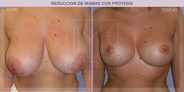 cirugía de reducción de mamas antes y después