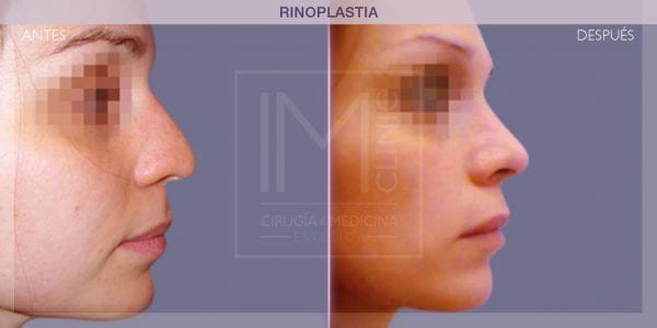 operacion rinoplastia antes y despues