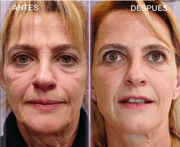 tratamiento de rejuvenecimiento facial full face