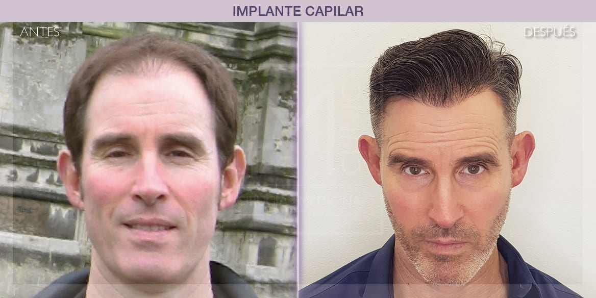 implante capilar antes y después