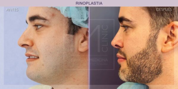 Rinoplastia en hombres