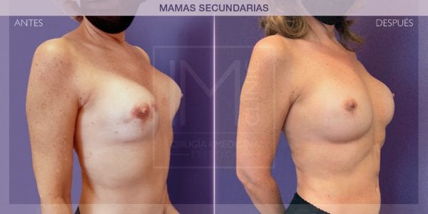 cirugía secundaria de mama antes y después