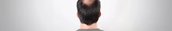 Cómo tratar la alopecia androgénica masculina