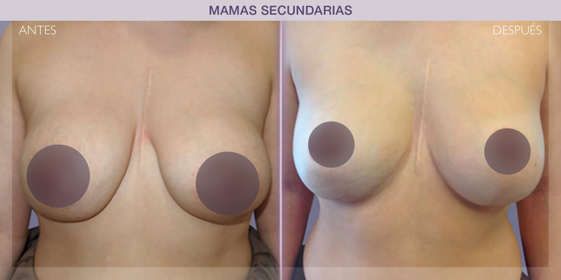 antes-despues-cambio-protesis2'