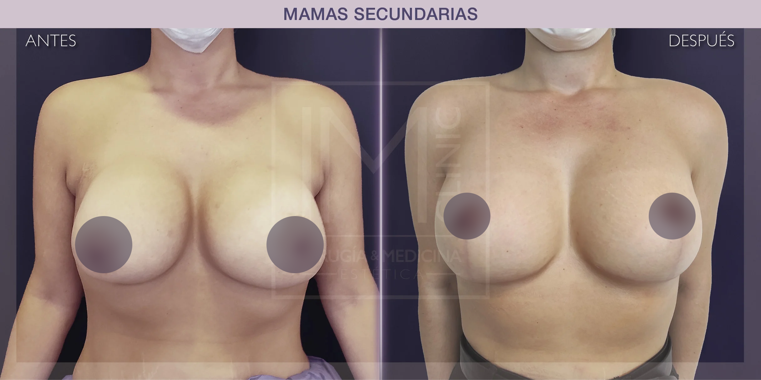 antes-despues-cambio-protesis3'