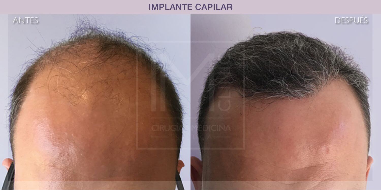 IC-AD-CAPILAR