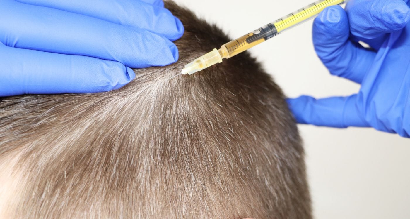 mesoterapia para alopecia