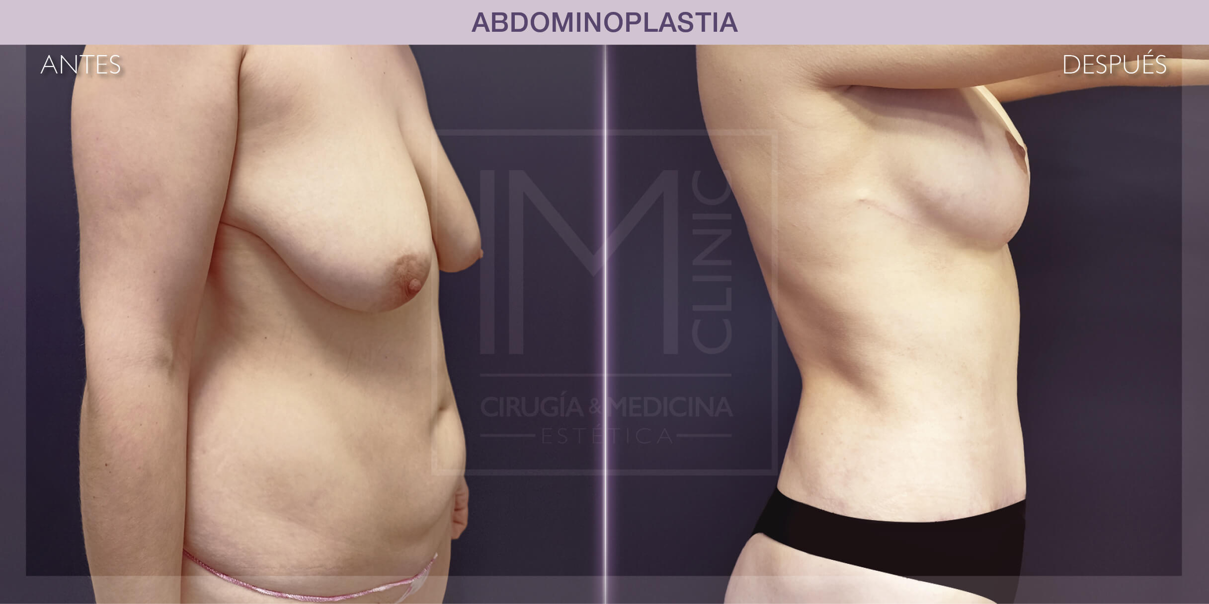 resultado-abdominoplastia-lifting-mamas'