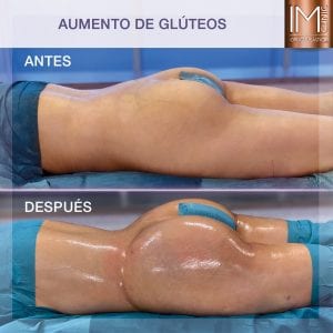 aumento de glúteos con técnica mixta