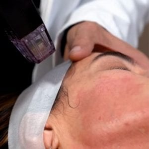 radiofrecuencia morpheus facial